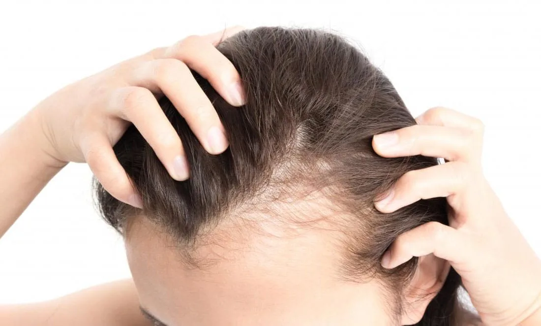 chute de cheveux