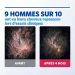 Deux gros plans du cuir chevelu comparent la densité des cheveux : "AVANT" montre un amincissement, alors qu'après 4 mois de Regaine - Mousse Minoxidil 5%, 3 x 60g, les cheveux semblent plus fournis. Le texte indique que 9 hommes sur 10 ont vu leur chevelure repousser.