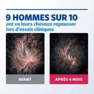 Deux gros plans du cuir chevelu comparent la densité des cheveux : "AVANT" montre un amincissement, alors qu'après 4 mois de Regaine - Mousse Minoxidil 5%, 3 x 60g, les cheveux semblent plus fournis. Le texte indique que 9 hommes sur 10 ont vu leur chevelure repousser.